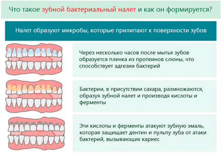 Бактеріальний зубний наліт - причини, ризики та засоби для його ліквідації