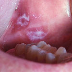 Inflamatiile pe gingii - o boala grava