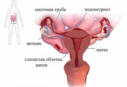 Terhesség endometriosis tüneteit, a diagnózis és a kezelés