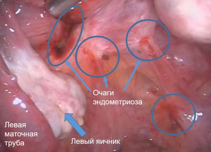 Terhesség endometriosis tüneteit, a diagnózis és a kezelés