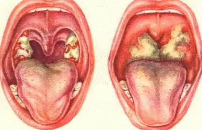 Болить вухо і горло з одного боку, болить гланди