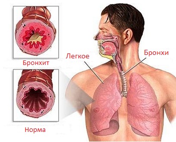 Simptomele de bronșită și tratamentul la adulți, cauze