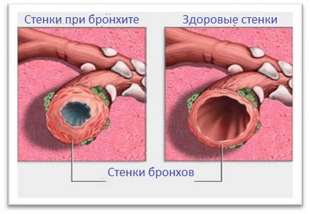 Бронхіт симптоми і лікування у дорослих, причини