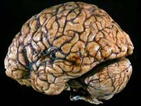 Чого очікувати від некрозу пухлин головного мозку
