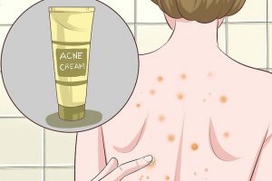 Curățarea spatelui de acnee din salon - descrierea și eficacitatea procedurii