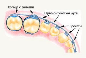 Ce este un sistem de ancorare sau suport, policlinică dentară gauză № 9 g