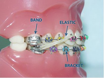 Ce este un sistem de ancorare sau suport, policlinică dentară gauză № 9 g