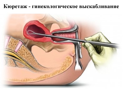 Diagnosticarea chiuretajului cavității uterine pentru hiperplazia endometrială