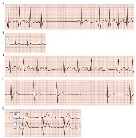 Diagnózis bradycardia sinus szindróma