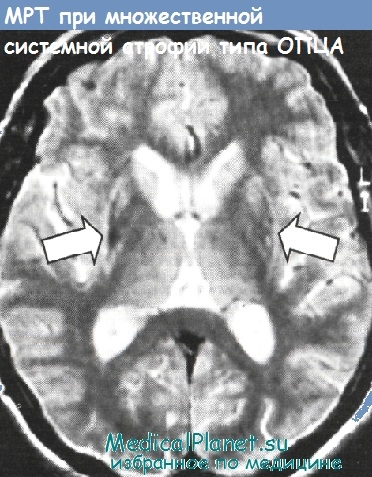 Diagnosticul diferențial al ataxiei cerebellar tardive idiopatice