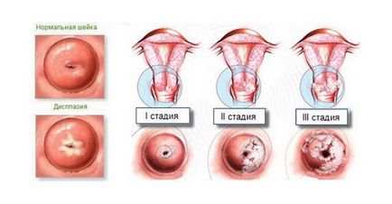 Displazia cervicală de 1 grad