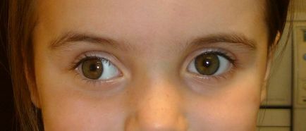 Exotropia la copii și adulți cauzează, diagnostic și tratament