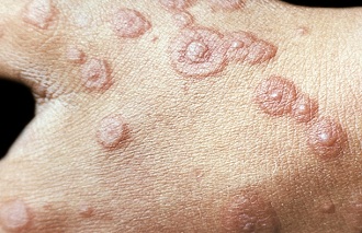 Erythema exsudativum mnogomorfnaya (EEM)