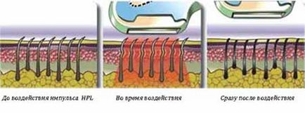 Photoepilators otthoni használatra - sensepil XL járványok (használat) Photoepilators otthoni használatra - sensepil XL kitörések