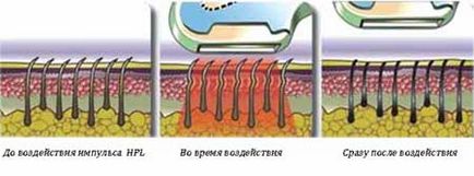 Фотоепилятори для домашнього використання - sensepil xl спалахів