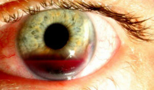 Гіфема очі - причини, симптоми, методи лікування