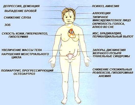 Hipotiroidismul - simptome, tratament, dietă pentru hipotiroidism