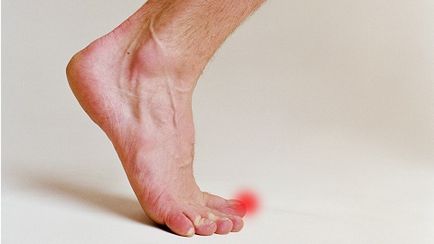 Nail gomba (gombák) köröm gomba