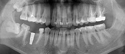 Implantológia Moszkva, egészségügyi központ szolgáltatások Kolomna ( „CIP”)