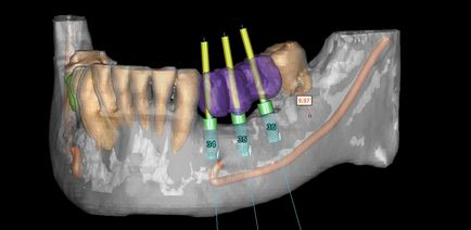 Implantológia Moszkva, egészségügyi központ szolgáltatások Kolomna ( „CIP”)