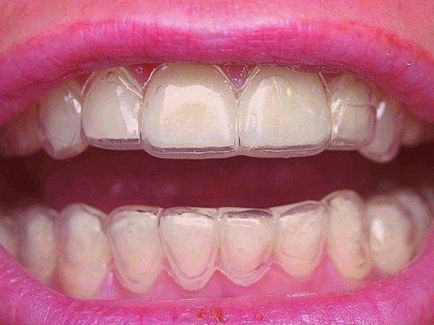 Hogyan lehet a legjobban összehangolni a fogak