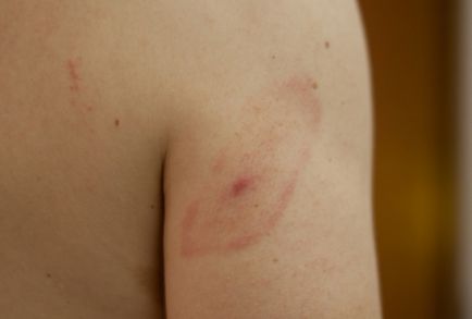 Cum se manifestă boala lyme - simptome de borrelioză