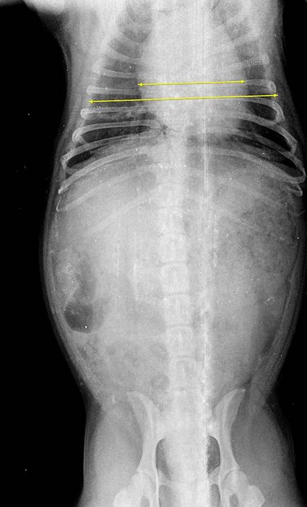 Cardiothoracic index (kardiális, mellkasi, kardio-mellkasi) a mellkasi röntgenfelvételek