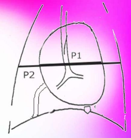 Кардиоторакального індекс (кардіально-торакальний, кардіо-торакальний) на торакальної рентгенограмі