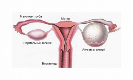 Chistul la începutul sarcinii - metode de tratament