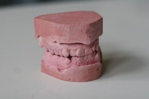 Crown pe dinte, după cum a pus, caracteristicile de funcționare