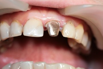 Crown pe dinte, după cum a pus, caracteristicile de funcționare