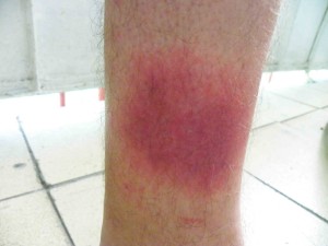 Червоні плями на ногах при варикозі - профілактика і лікування