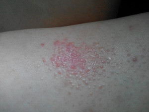 Pete roșii pe picioare cu vene varicoase - prevenire și tratament