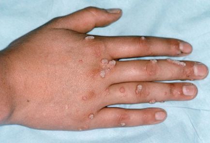 Tratamentul verucilor, scabiei, molluscum contagiosum și remedii folclorice (tratament