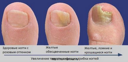 Лікування грибка на нігтях ніг і рук