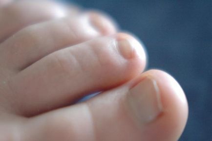 Лікування грибка нігтів народними засобами користь часнику