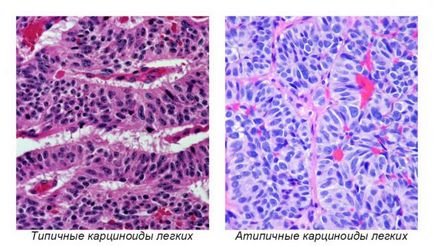 Tratamentul unei tumori pulmonare carcinoide în Israel