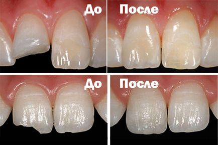 Лікування передніх зубів ціни і вартість в москві, лікування переднього зуба в стоматології