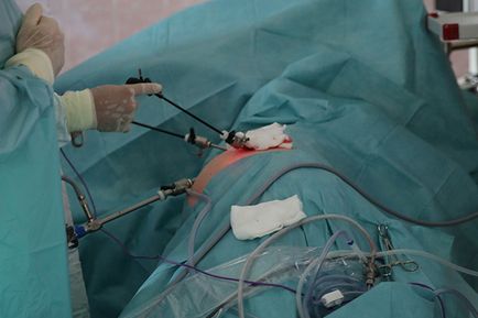 Chirurgie minim invazivă (endoscopică, laser)