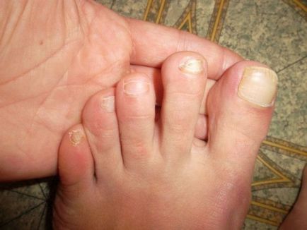 Марганцівка від грибка нігтів на ногах властивості і способи застосування