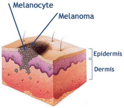 Melanomul - ceea ce este