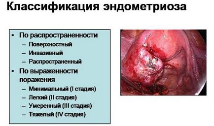 În ce zi a ciclului faceți uzi pentru endometrioză