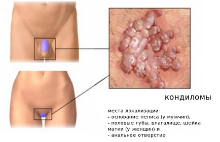 Metode populare de tratare a verucilor (papiloame) cu cartofi, peroxid de hidrogen, ulei, celandină