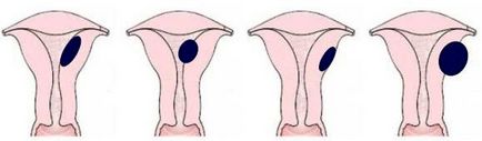 Adenomioza focală a tratamentului uterului, cauze, simptome