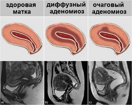 Adenomioza focală a tratamentului uterului, cauze, simptome