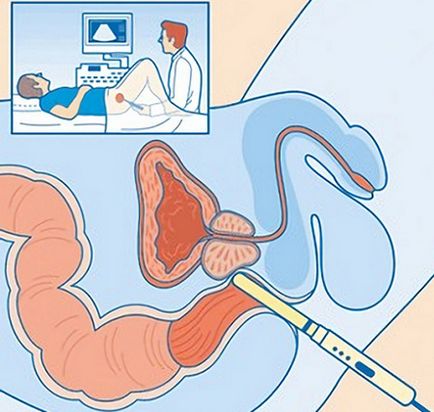 Testiculul tumoral la bărbați cauzează, simptomele și tratamentul la un băiat