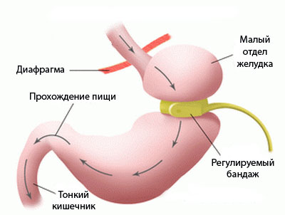 Principalele metode de combatere a obezității sunt slabe