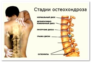 Osteocondroza pe nervi și mijloace de tratament