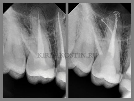 Переліковування каналів зуба з мікроскопом в складних випадках, perfectsmile