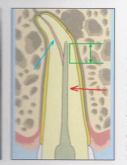 Retratarea canalelor dentare cu microscop în cazuri dificile, perfectsmile